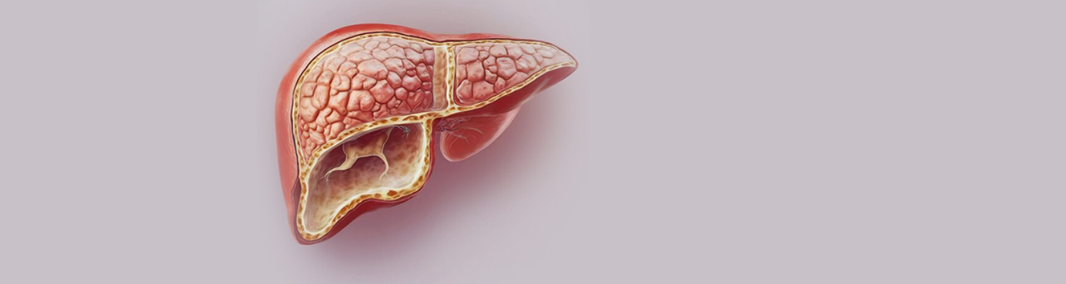 همه‌چیز درباره کبد چرب و علائم آن